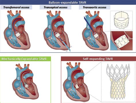 Contemporary Results of Aortic Valve Repair for Congenital .